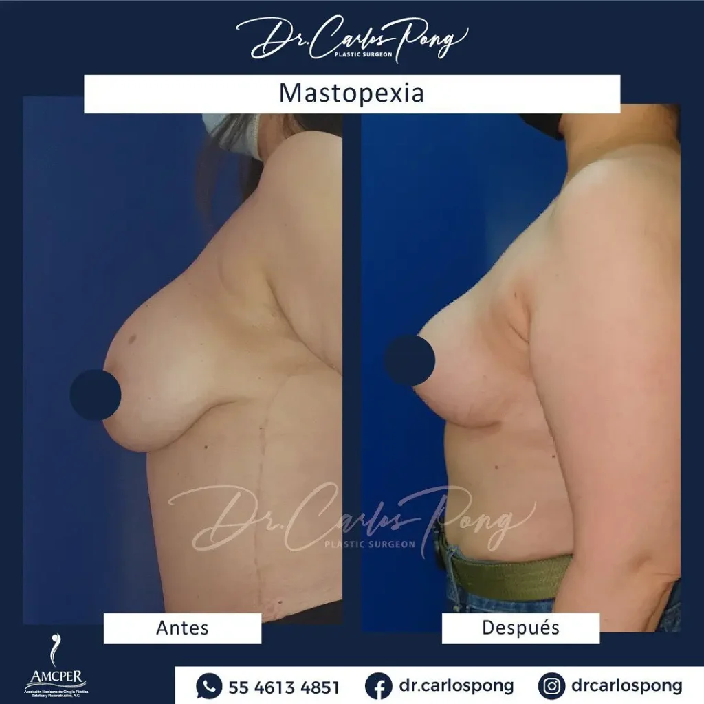 Mastopexia 5