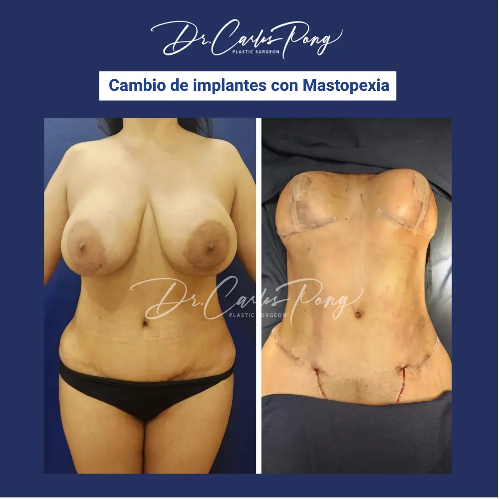 Cambio de implantes con mastopexia 4