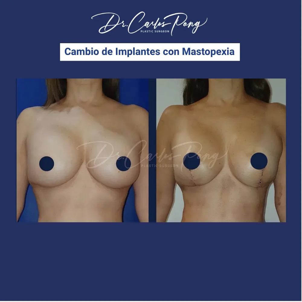 _Cambio de implantes con mastopexia 6