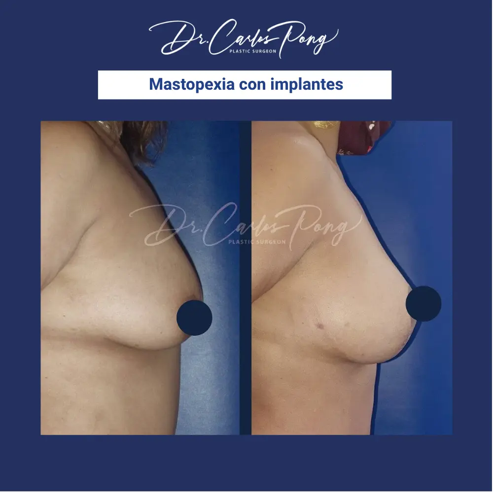 Mastopexia con implantes 1