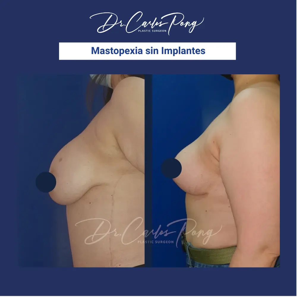 Mastopexia sin implantes 1.