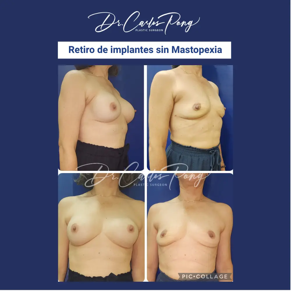 Retiro de implantes sin mastopexia 1