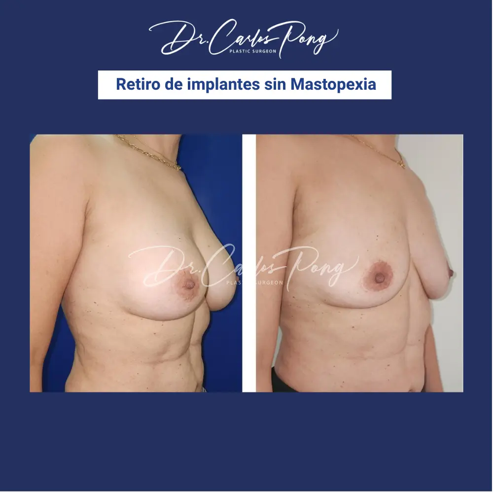 Retiro de implantes sin mastopexia 2